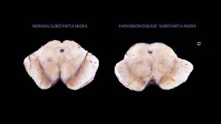 Parkinson Disease Pathophysiology Animation [upl. by Suiramad]