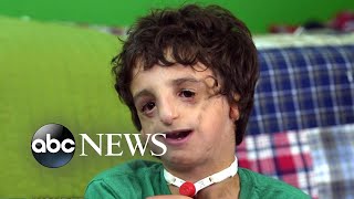 Boy living with Treacher Collins has 53 surgeries by age 11 2020 Part 2 [upl. by Assenyl]