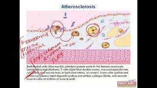 Atherosclerosis and Arteriolosclerosis CVS pathology video part 25 from USMLE First Aid Step one [upl. by Schweitzer]