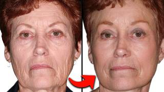 Is CO2 Fractional Laser Resurfacing WORTH IT Plastic Surgeon Answers [upl. by Yornoc584]