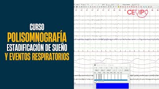 Estadificación de Sueño y Eventos Respiratorios  Polisomnografia  Curso [upl. by Latt]