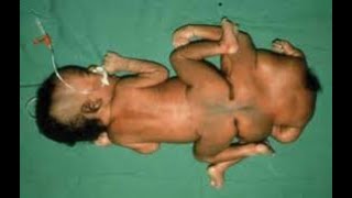 Heteropagus twins  Assymetrical parasitic twin  Epigastric heteropagus twins [upl. by Beedon483]