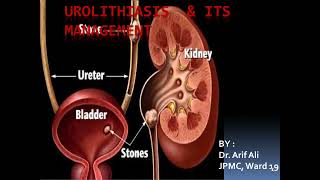 Urolithiasis Surgery Lecture  Kidney Stones signs symptoms risk factor pathophysiology treatment [upl. by Verneuil]