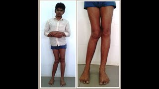 Valgus knee Deformity treated with Ilizarov method [upl. by Collyer924]