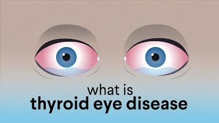 What is Thyroid Eye Disease TED [upl. by Lobel123]