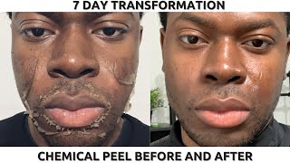 CHEMICAL PEEL ON BLACK SKIN  FULL PROCESS BEFORE amp AFTER  HYPERPIGMENTATION amp DARK SPOTS [upl. by Sillyhp]