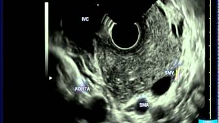 Pancreatic Ascariasis Causing Acute Pancreatitis [upl. by Wendolyn]