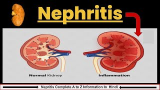 Nephritis in Hindi  Causes Symptoms amp Treatment  Nephrotic Syndrome  Nursing lecture [upl. by Dodson]