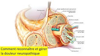 Comment reconnaître et gérer la douleur neuropathique [upl. by Demmahom]