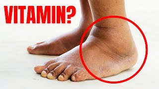 1 Vitamin to Eliminate Swelling in Feet and Legs [upl. by Hsital]