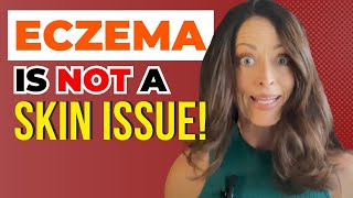 Eczema and the Gut  Getting to the Root Causes [upl. by Hokanson]