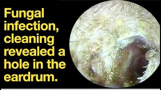 Fungal infection cleaning revealed a hole in the eardrumear wax removal  ear cleaning  ASMR [upl. by Corliss]