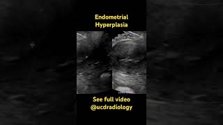 Endometrial hyperplasia  radiology radiologist doctor medicalschool ultrasound [upl. by Nosnevets]