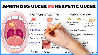 Aphthous ulcer Aphthous stomatitis vs Herpetic ulcer  How to diagnose [upl. by Dafna]