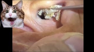 Removing impacted ear wax [upl. by Piderit646]