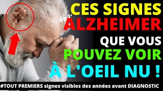 4 signes visibles à loeil nu et précoce de la maladie de lAlzheimer [upl. by Ecnav]