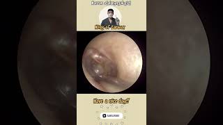 고막염증제거 otitismedia needle aspiration satisfyingvideo ENT [upl. by Kreindler]