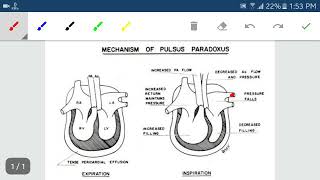 Pulsus paradoxus [upl. by Anuaik]