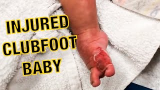 MY CLUBFOOT BABY HAD A HORRIBLE TOE INJURY AT ONLY 4 WEEKS OLD 2019 [upl. by Lemhaj]