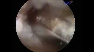 HIP ARTHROSCOPY BONEGRAFTING AN ACETABULUM CYST DR ROBERT RUPP [upl. by Justino362]