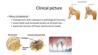 Hyperaldosteronism  Cushing syndrome [upl. by Lyrej]