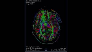 Diffusion tensor imaging DTI is an MRI technique that analyzes the anatomy of nerve cells [upl. by Navnod]