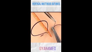 Vertical Mattress Suture  Best Suture Techniques [upl. by Enelrac]