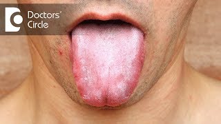 Is Oral Candidiasis related to HIV status  Dr Mohammed Fayaz Pasha [upl. by Joshi]