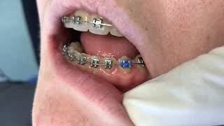 Orthodontic ligation Figure of 8 tie [upl. by Anialad]