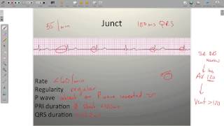 ECG Junctional Rhythms [upl. by Thoer]