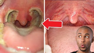 Tonsil Stone  Tonsillectomy [upl. by Toh584]