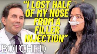 NonSurgical Nose Job Nightmare Melissa Lost Half Her Nose  Botched  E [upl. by Nuahsak]