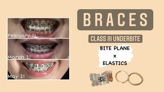 BRACES Underbite  Philippines [upl. by Luiza]