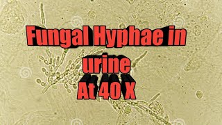 Fungal hyphae in urine microscopy at 40X [upl. by Lenahc]