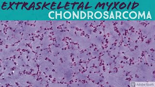 Extraskeletal Myxoid Chondrosarcoma 5Minute Pathology Pearls [upl. by Benioff235]