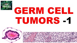 OVARIAN TUMORS  Part 4 Germ cell tumors Dysgerminoma yolk sac tumor  Pathology [upl. by Reisch]