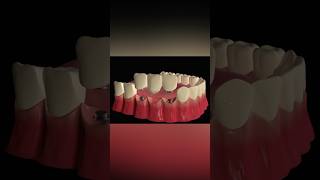 Implant Supported Dental Bridge dentist medicalanimation [upl. by Merceer]