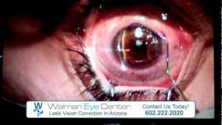 Lasik Vision Correction at Walman Eye Center  Phoenix Arizona [upl. by Neerac]