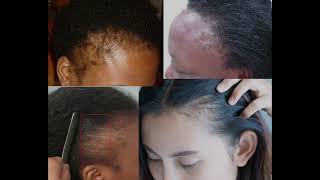 DANGERS OF HAIR BONDING GLUE [upl. by Llenad]