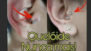 Granuloma no tragus nunca mais [upl. by Nereus272]