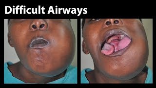 VividTrac  Nasal Intubation Difficult Airway [upl. by Cristy]