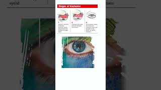 Trachoma Free India 🇮🇳freeindia trachoma proud eyes see positivity ytshorts yt ytshort [upl. by Varian]