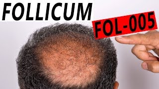 Follicum FOL 005 Anti Hair Loss Treatment UPDATE [upl. by Sivrep]