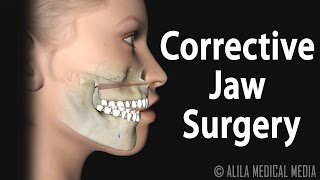 Corrective Jaw Orthognathic Surgery Animation [upl. by Talbott]