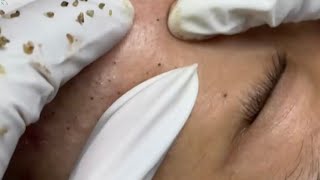 Big Cystic Acne Blackheads Extraction Blackheads amp Milia Whiteheads Removal Pimple Popping [upl. by Secnirp878]