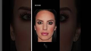 Rhinoplasty Transformation  Dr Paul E Chasan [upl. by Anairt584]