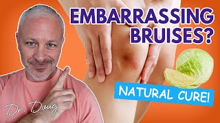 BRUISES How to get rid of them Fast  Dr Doug Willen [upl. by Aivital637]