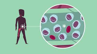 CLL  Wat is Chronische Lymfatische Leukemie [upl. by Reltuc]