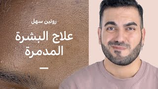 روتين لعلاج التهاب وتهيج البشرة 🥵 تصليح حاجز البشرة للرطوبة [upl. by Atikram]