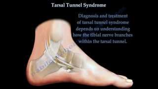 Tarsal Tunnel Syndrome  Everything You Need To Know  Dr Nabil Ebraheim [upl. by Aeki340]